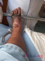 "HB Güvən" klinikasının professoru qazinin ayağını görün nə hala saldı - DƏHŞƏTLİ FOTOLAR