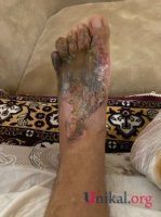 "HB Güvən" klinikasının professoru qazinin ayağını görün nə hala saldı - DƏHŞƏTLİ FOTOLAR