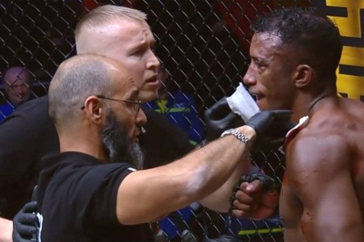 MMA döyüşçüsü rəqibin qulağını qopardı MMA döyüşçüsü rəqibin qulağını qopardı
